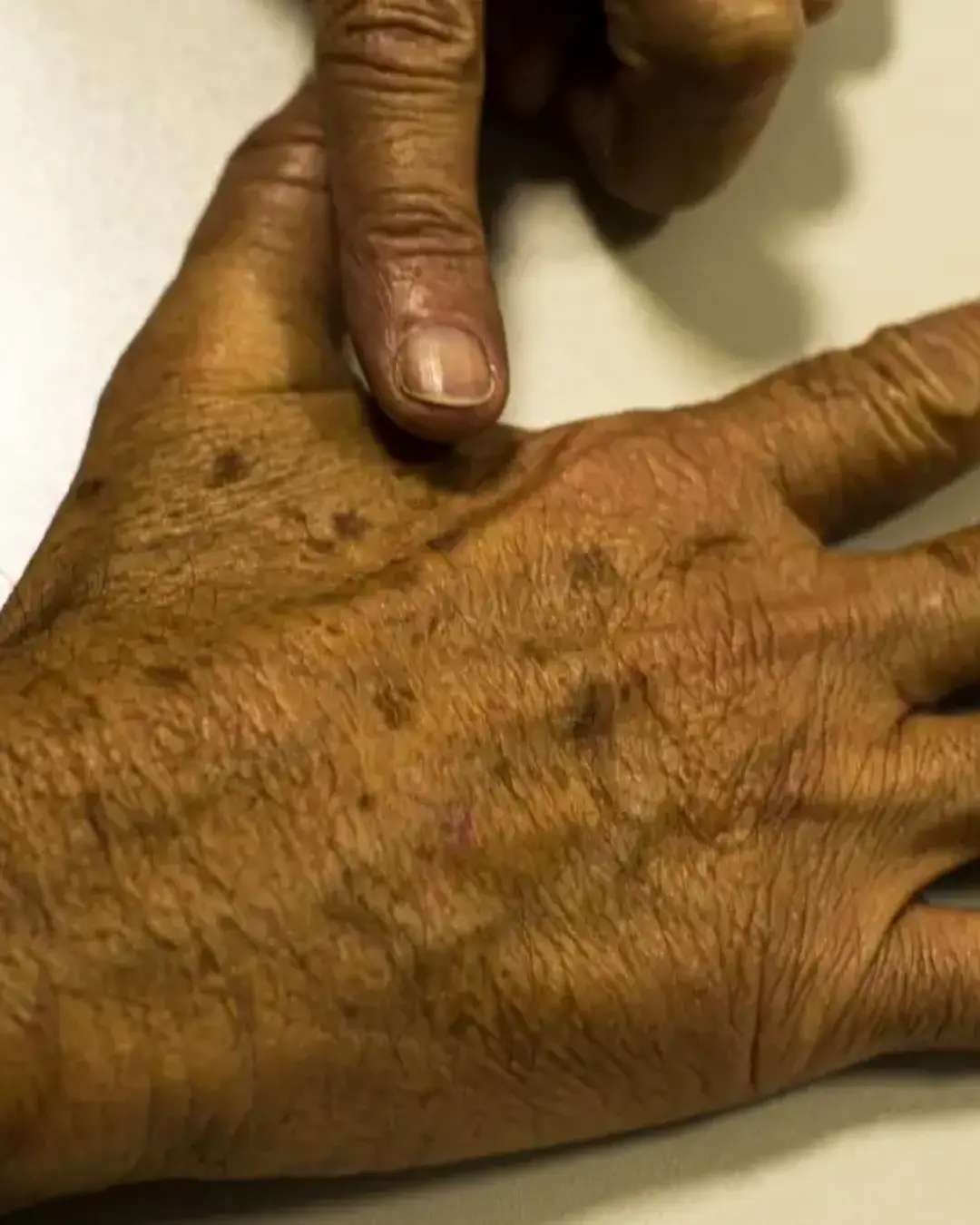 Câncer de pele registra R$ 4,6 milhões em custos hospitalares em quase dois anos