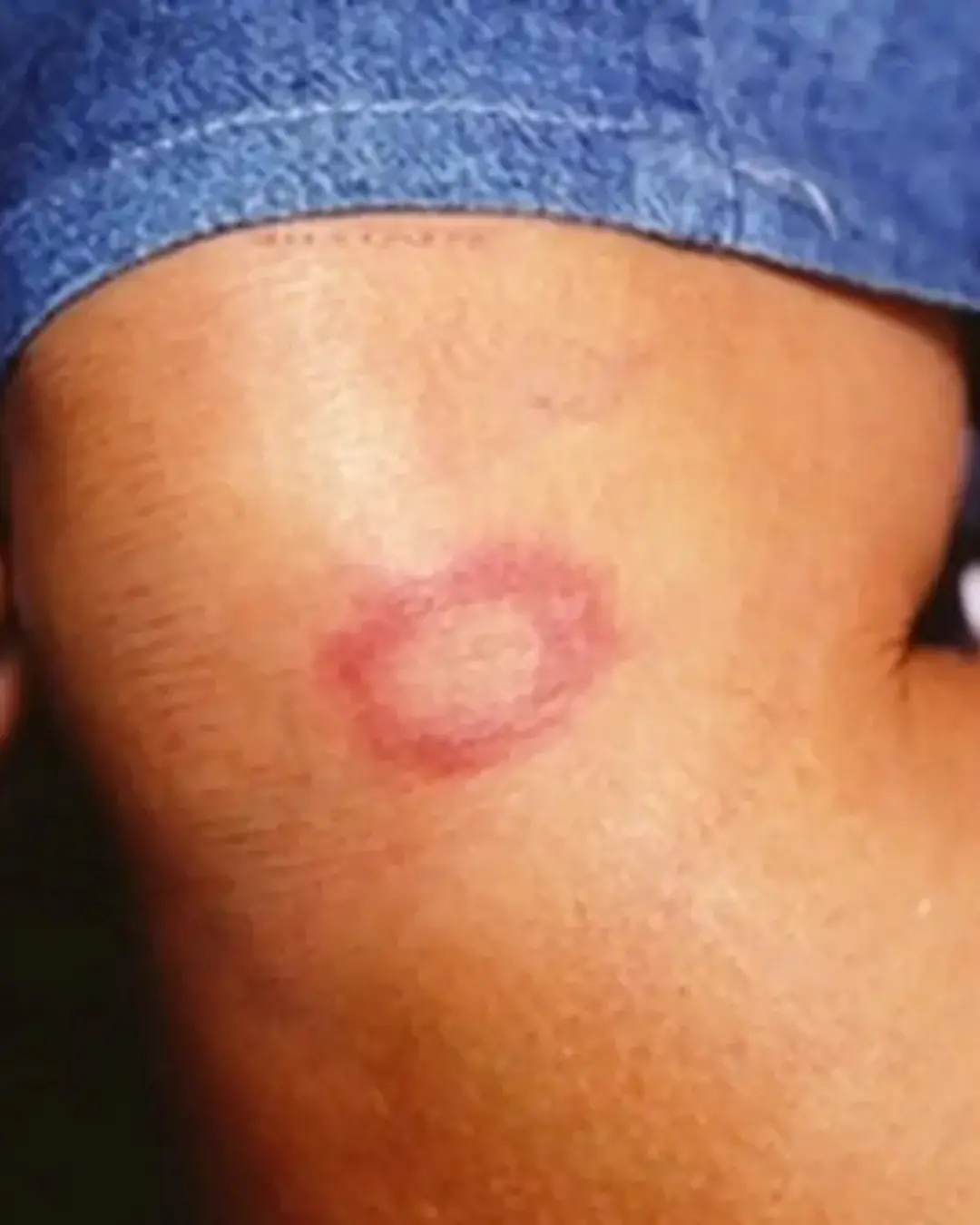 Hanseníase: sintomas, transmissão e como combater o estigma da doença