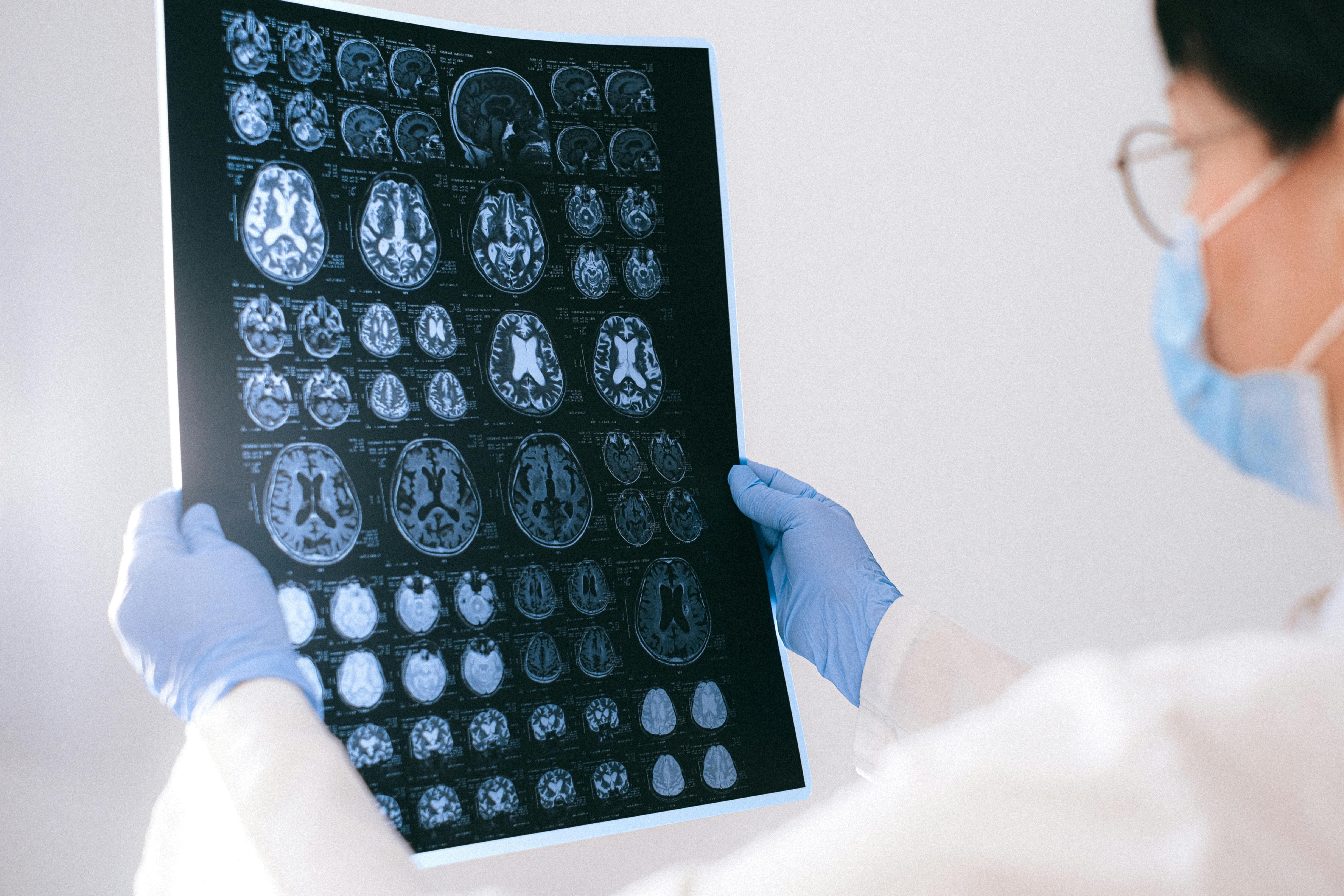 BrainAge: tecnologia indica a idade cerebral